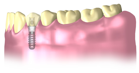 Implantate Barsinghausen